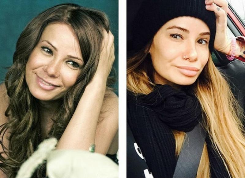 Фото До и после операци Айза анохина липосакция до и после