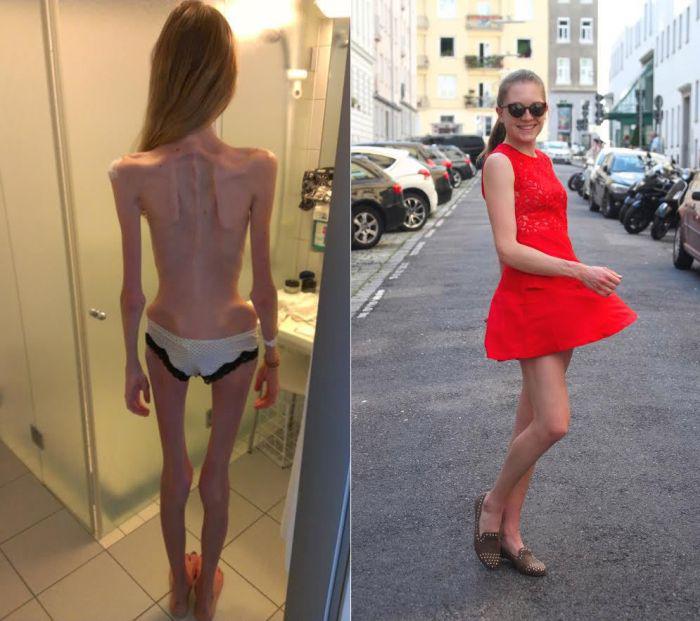 В возрасте 17 лет девушке поставили диагноз анорексия, она практически ниче...