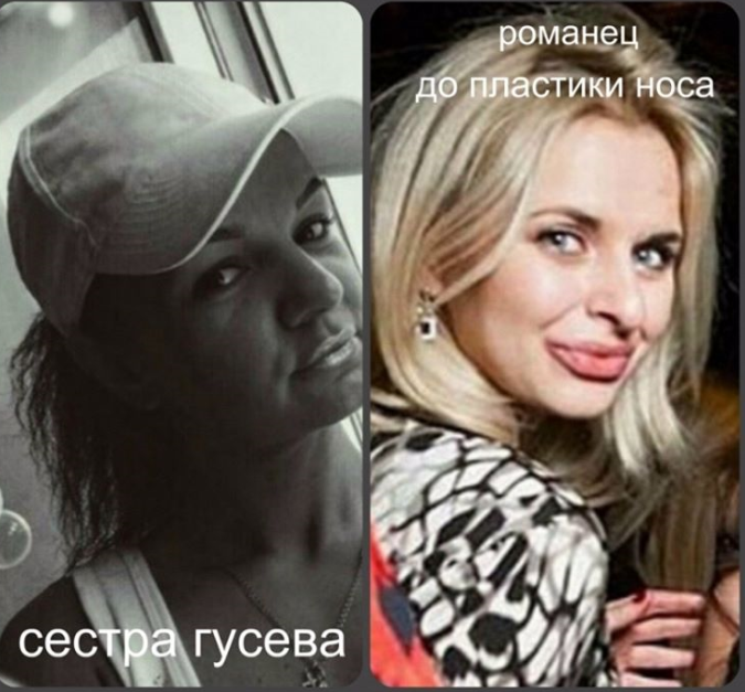 Гусева До И После Пластики Фото